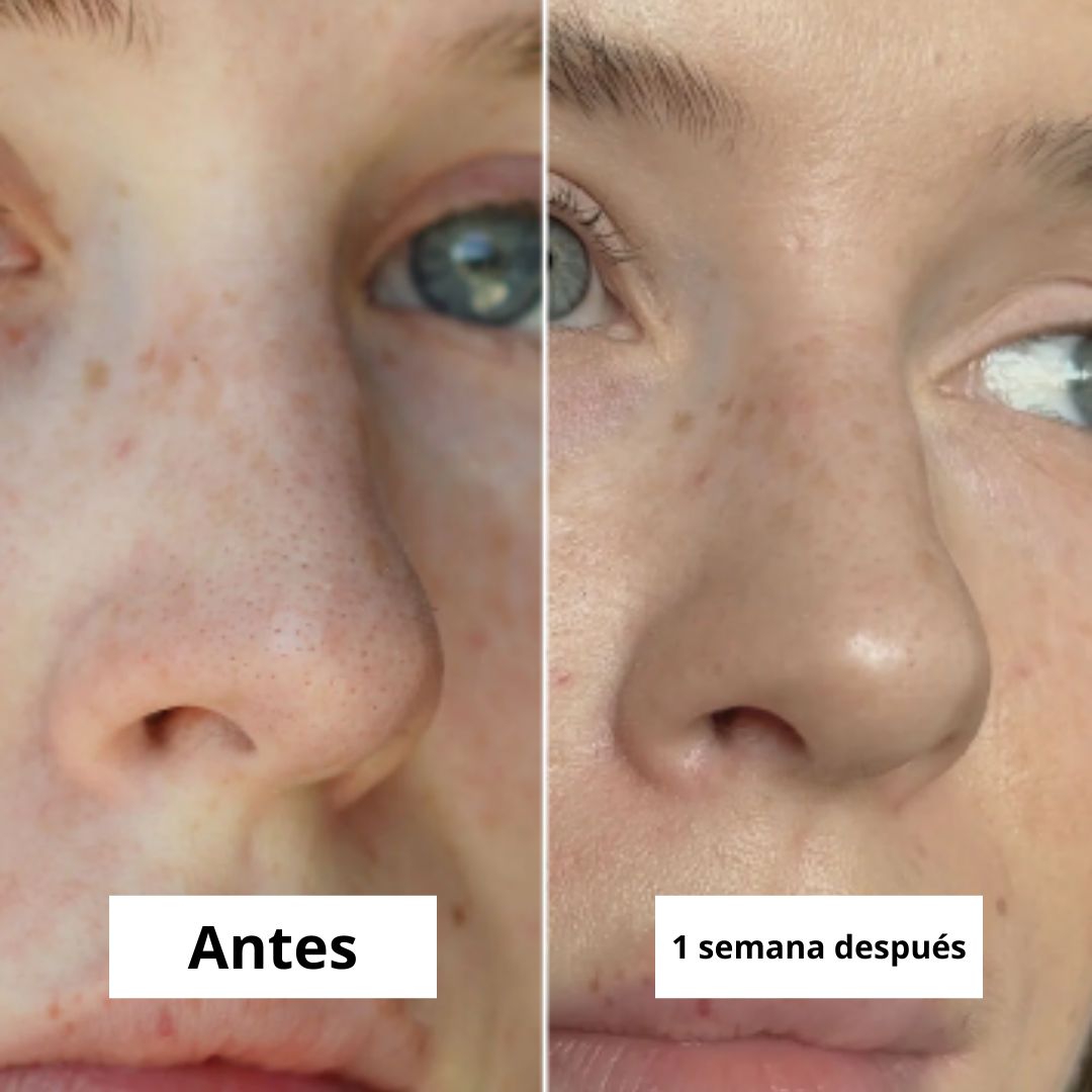 Parches antiacné de hidrocoloide