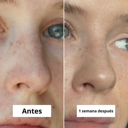 Parches antiacné de hidrocoloide