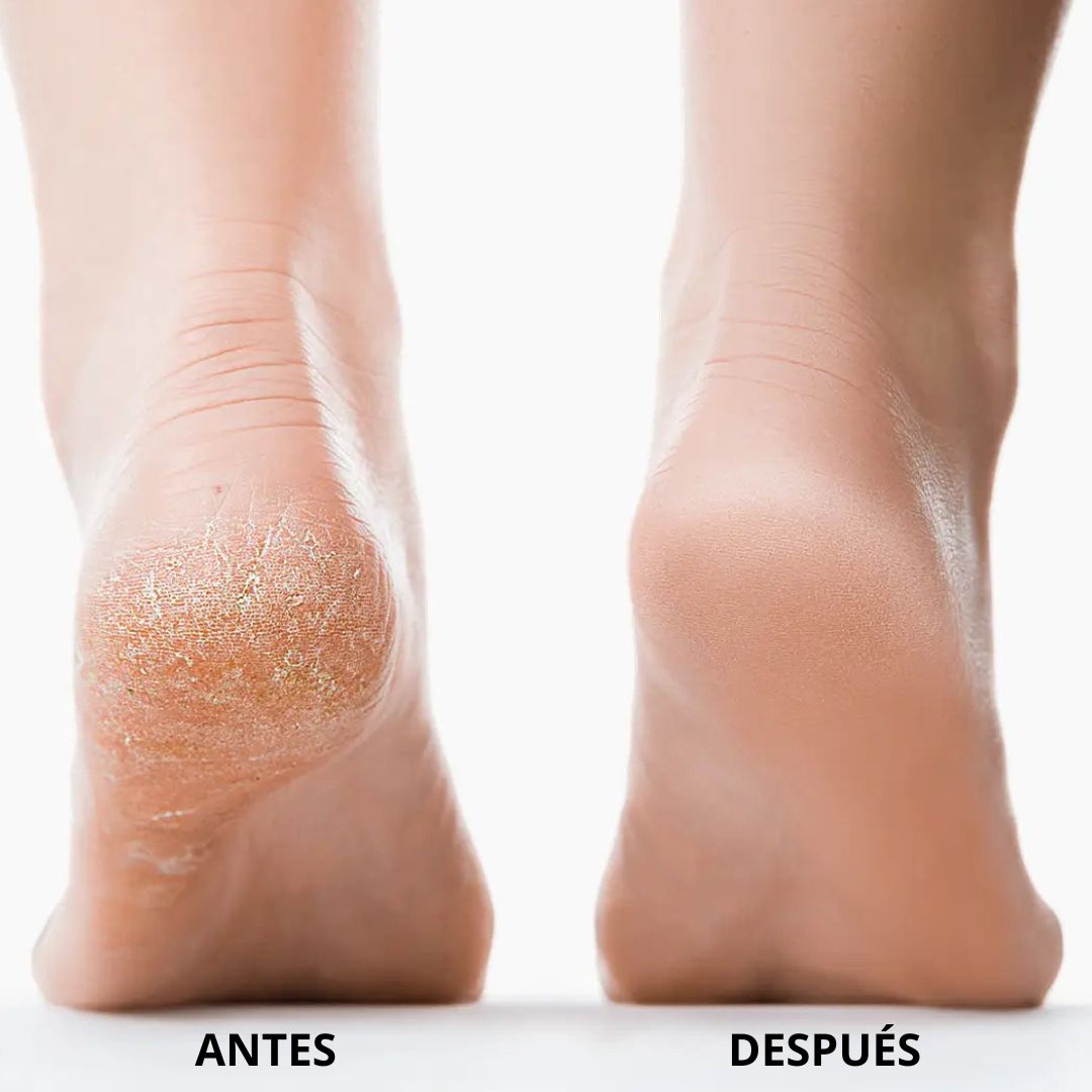 Nuve 3.0 - Removedor de callos