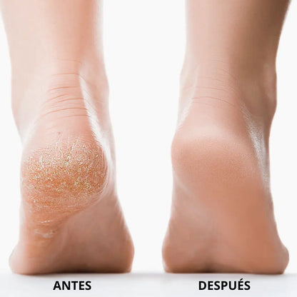 Nuve 3.0 - Removedor de callos